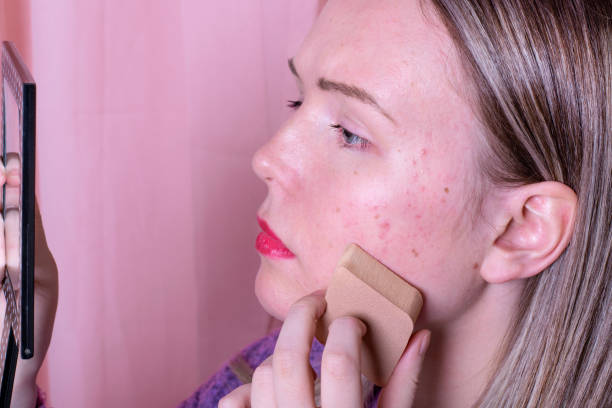 Effective Makeup Tips for Hiding Acne